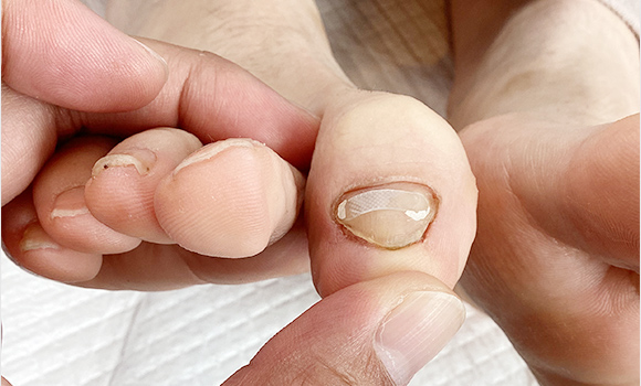 専用マシンで角質を削る