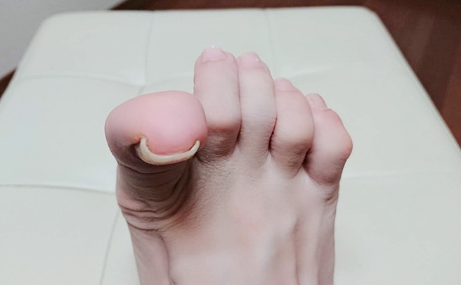 巻き爪